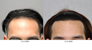 Cấy tóc FUE 2500 nang, kết quả sau 10 tháng - case 98