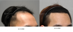 Cấy tóc FUE 2500 nang, kết quả sau 10 tháng - case 98