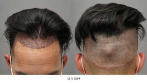 Cấy tóc FUE 2500 nang, kết quả sau 10 tháng - case 98