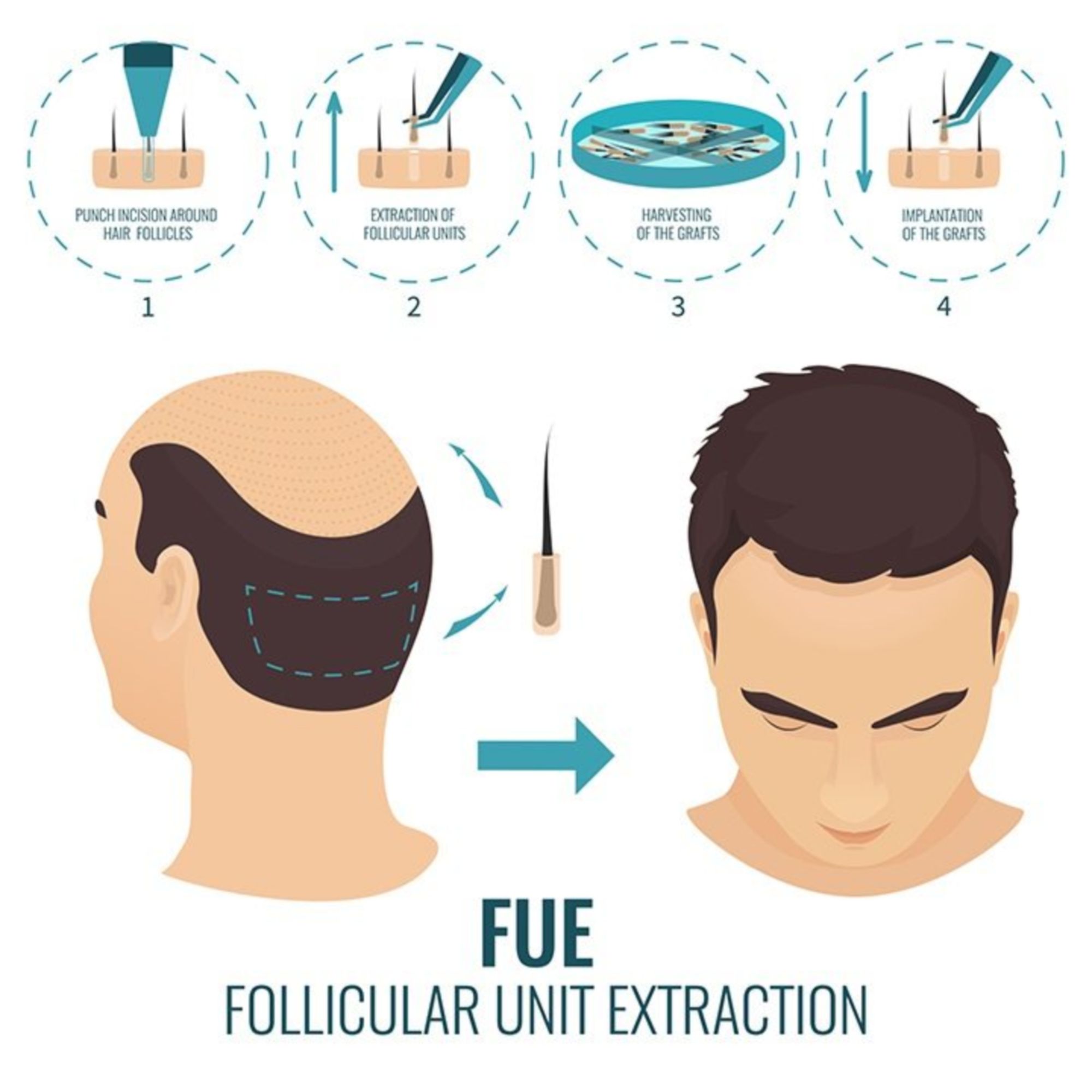 Cấy tóc FUE: Giải pháp khắc phục hói đầu, tóc thưa mỏng không để lại sẹo