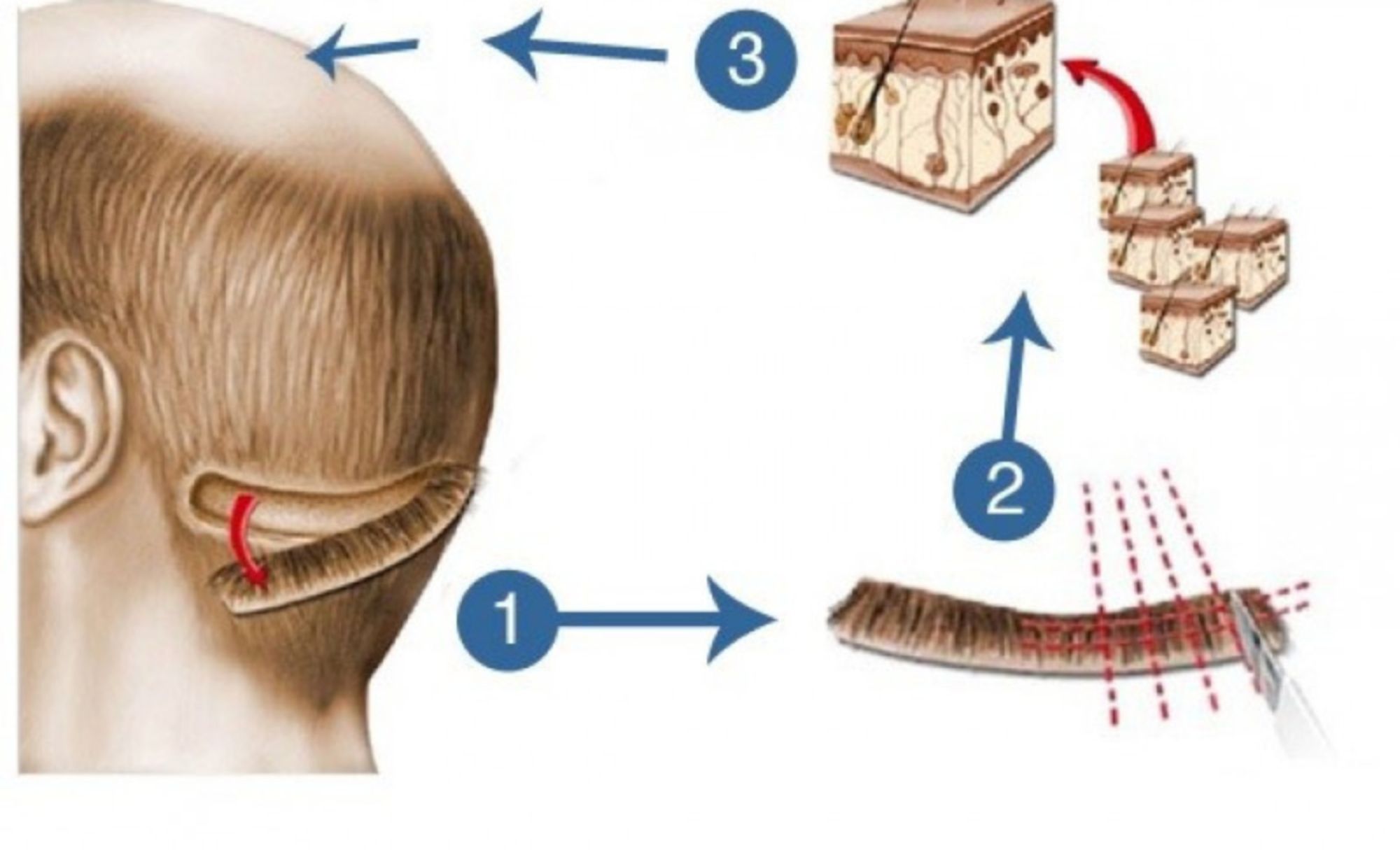 Cấy tóc FUT là gì, giá bao nhiêu và có gì khác so với các phương pháp cấy tóc vĩnh viễn khác?