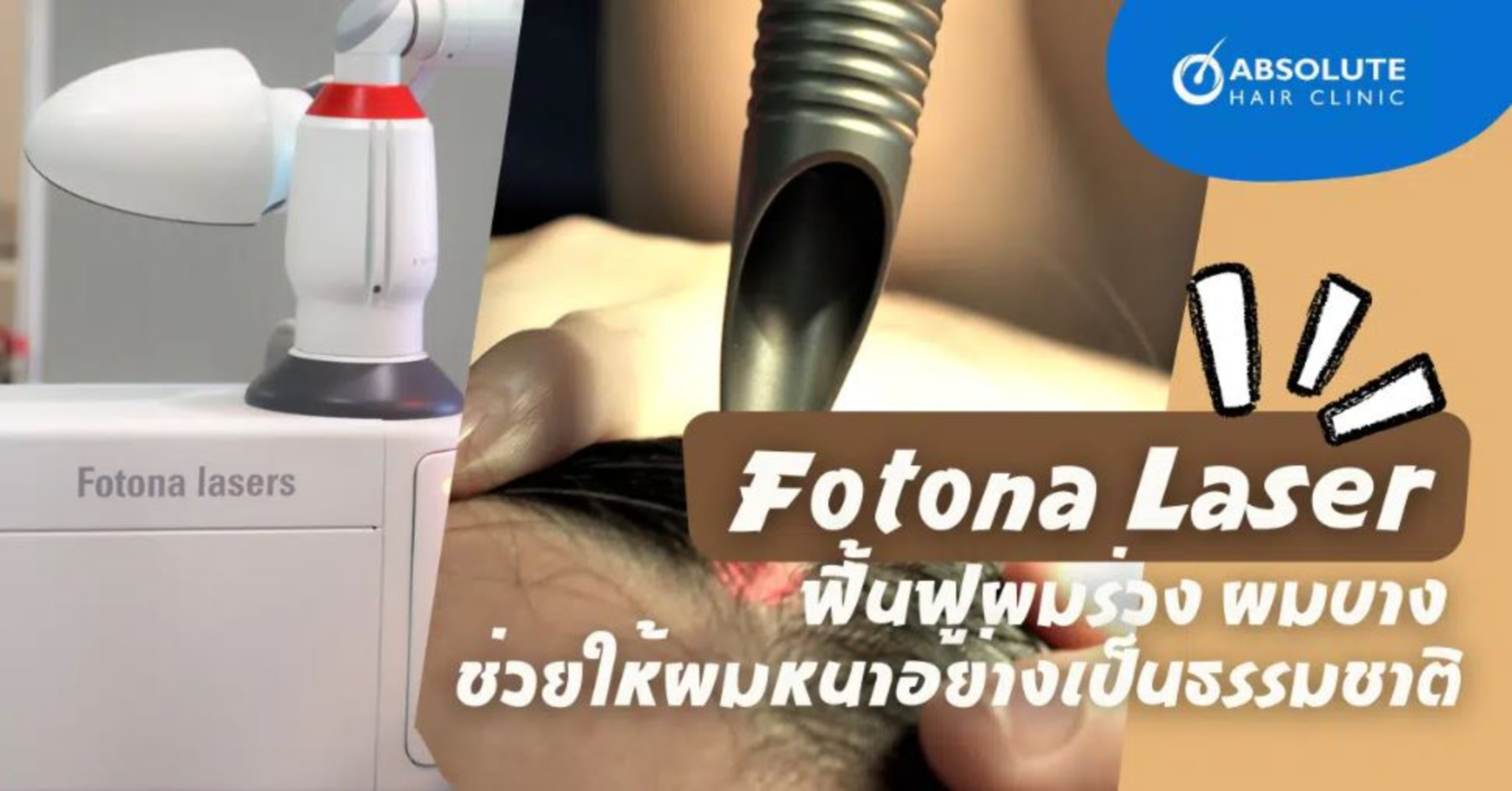 Laser Fotona - giải pháp điều trị tóc rụng, tóc thưa mỏng và làm dày tóc một cách tự nhiên