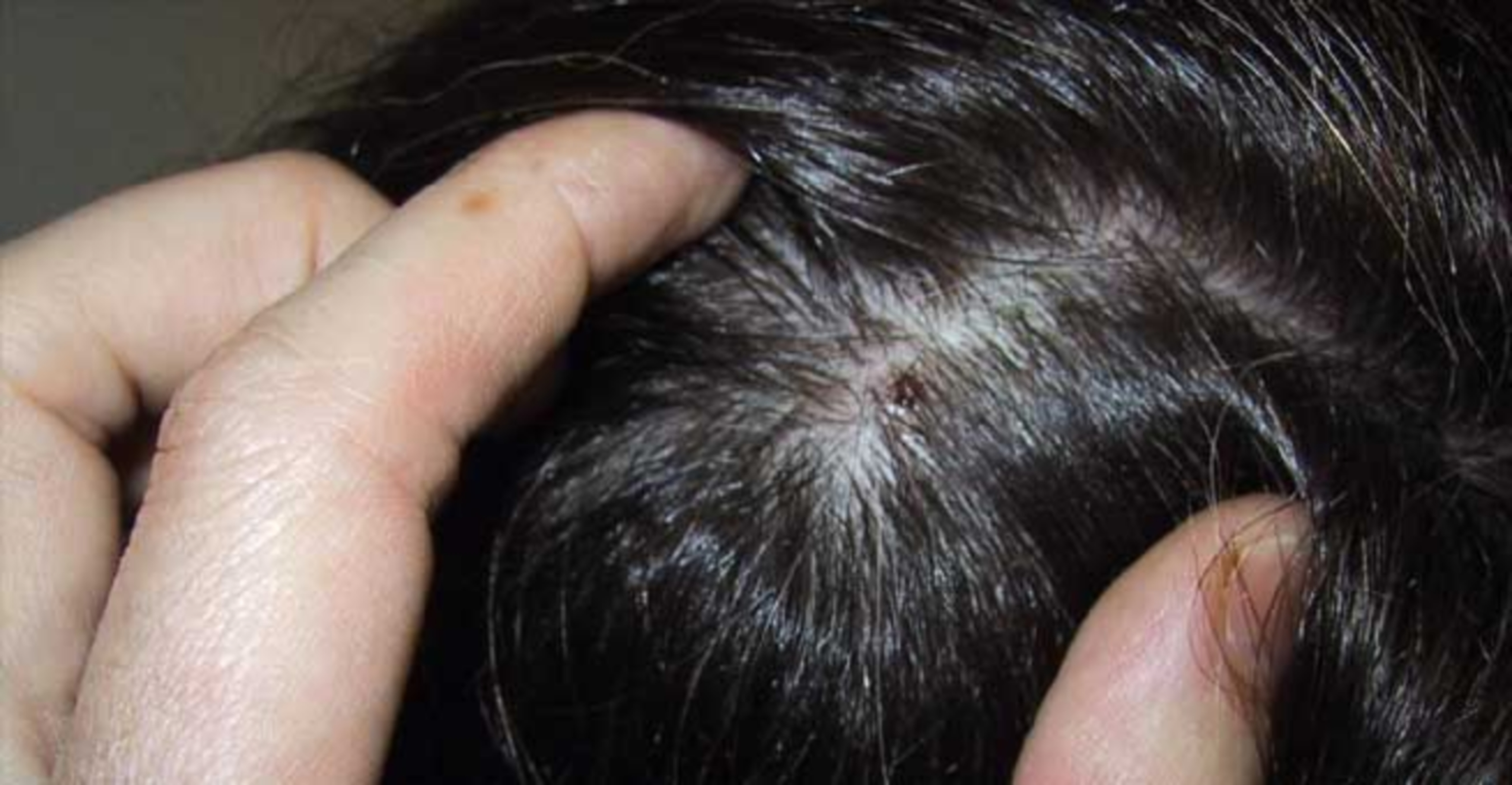 Mụn trên da đầu có liên quan đến vi khuẩn hay viêm nhiễm?
