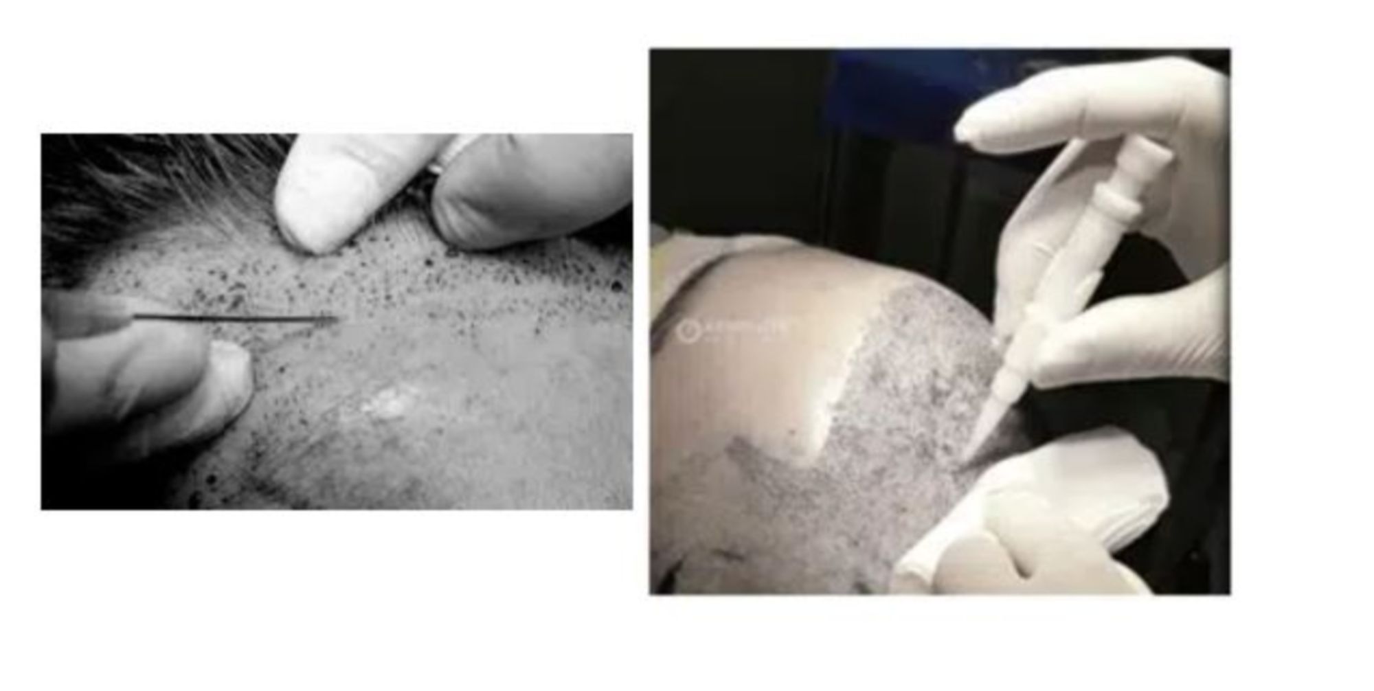 quy trinh cay toc 11