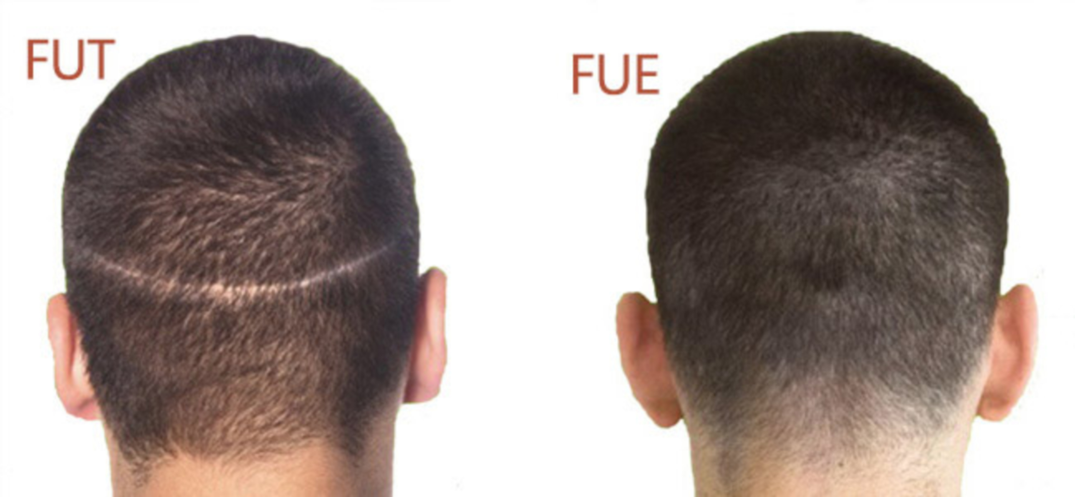 So sánh sự khác nhau giữa cấy tóc FUE và FUT, ưu nhược điểm của từng kỹ thuật, cái nào tốt hơn?