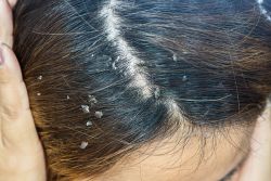 Da đầu khô, bong tróc và ngứa: Nguyên nhân do đâu và điều trị bằng cách nào?
