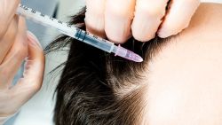 Cấy tóc có đau không? Cấy tóc FUE và cấy tóc FUT phương pháp nào đau hơn?