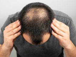 Hói đầu: Nguyên nhân, dấu hiệu cảnh báo và cách điều trị