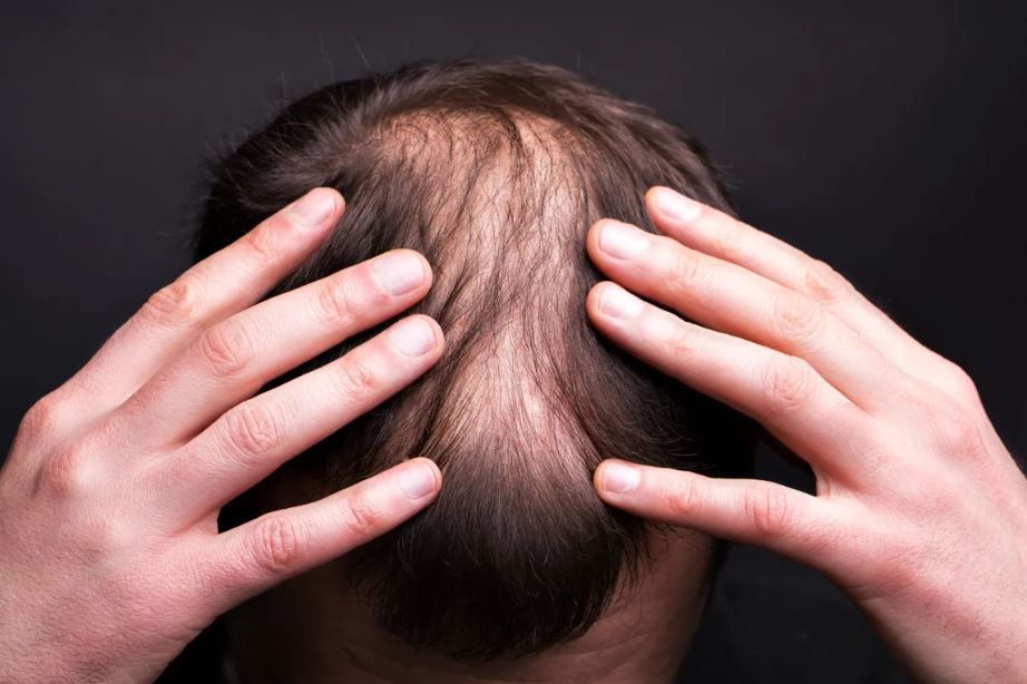 Rụng tóc telogen effluvium Triệu chứng nguyên nhân và cách điều trị