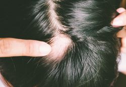 Rụng tóc từng mảng: Nguyên nhân và cách điều trị