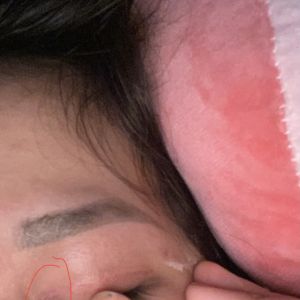 Cắt mí xong bị nổi mụn