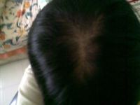 Bao lâu thì Minoxidil mới phát huy tác dụng?