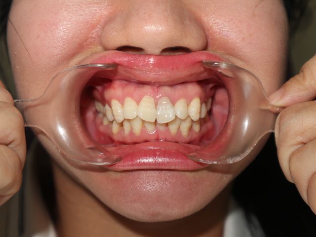 Nên niềng mắc cài hay invisalign cho tình trạng răng khấp khểnh vùng răng cửa, hô ở mức trung bình