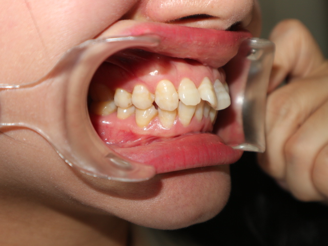 Mắc cài hay Invisalign hiệu quả hơn cho răng khấp khểnh vùng răng cửa và có hô ở mức trung bình