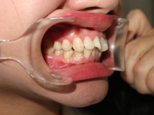 Nên niềng mắc cài hay invisalign cho tình trạng răng khấp khểnh vùng răng cửa, hô ở mức trung bình
