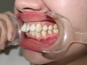 Nên niềng mắc cài hay invisalign cho tình trạng răng khấp khểnh vùng răng cửa, hô ở mức trung bình