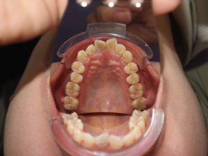 Nên niềng mắc cài hay invisalign cho tình trạng răng khấp khểnh vùng răng cửa, hô ở mức trung bình