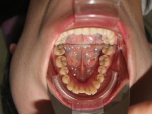 Mắc cài hay Invisalign hiệu quả hơn cho răng khấp khểnh vùng răng cửa và có hô ở mức trung bình