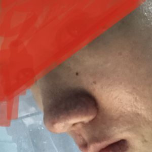 Cánh mũi, đầu mũi to (giải pháp an toàn)