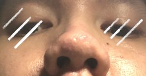 Cánh mũi, đầu mũi to (giải pháp an toàn)