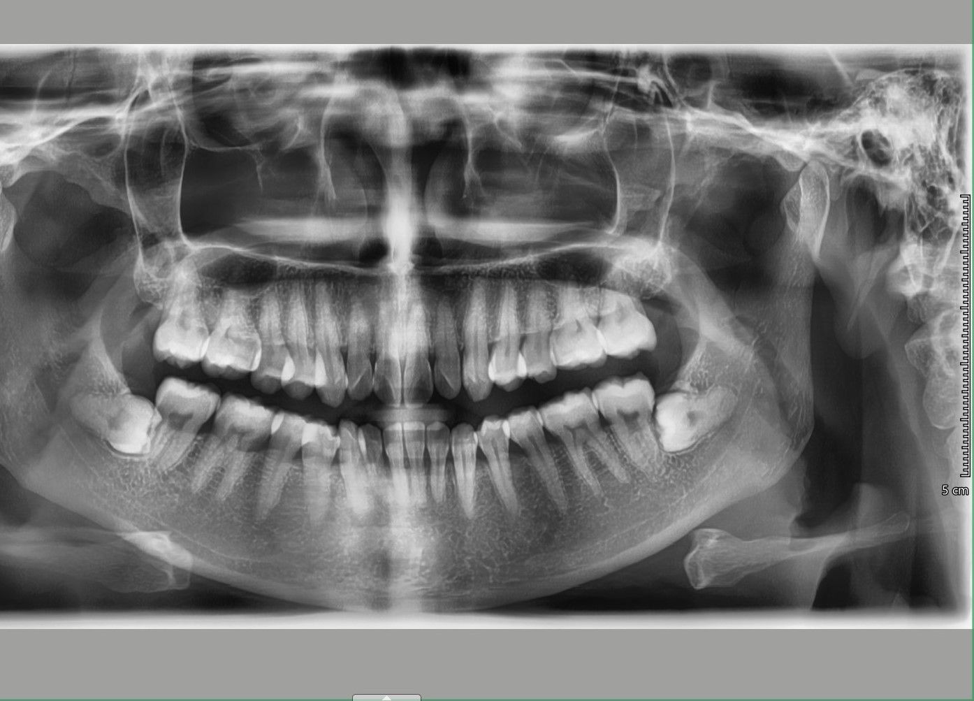 Nên niềng mắc cài hay invisalign cho tình trạng răng khấp khểnh vùng răng cửa, hô ở mức trung bình