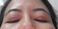 Sau khi cắt mi phần mí mắt trên khi nhìn xuống có nếp trắng cộm lên ngay trên đường cắt