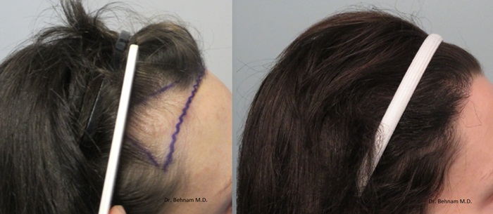 Giải quyết hói trán ở phụ nữ bằng phương pháp cấy tóc