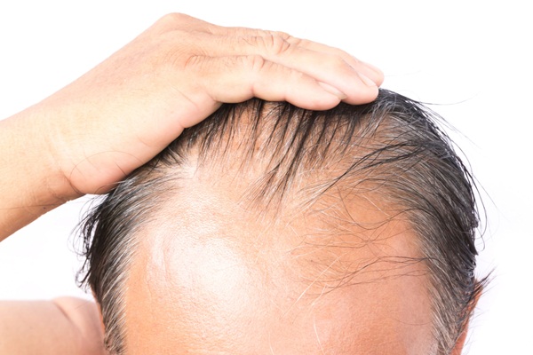 Các cách khắc phục rụng tóc tóc thưa mỏng và hói đầu ở người cao tuổi