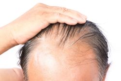 Các cách khắc phục rụng tóc, tóc thưa mỏng và hói đầu ở người cao tuổi
