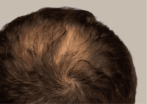 Các cách khắc phục tóc thưa mỏng ở đỉnh đầu