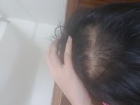 Rụng tóc