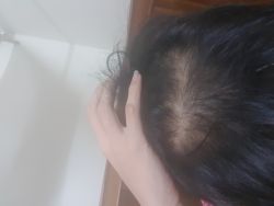 Rụng tóc