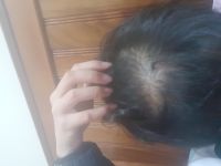 Rụng tóc