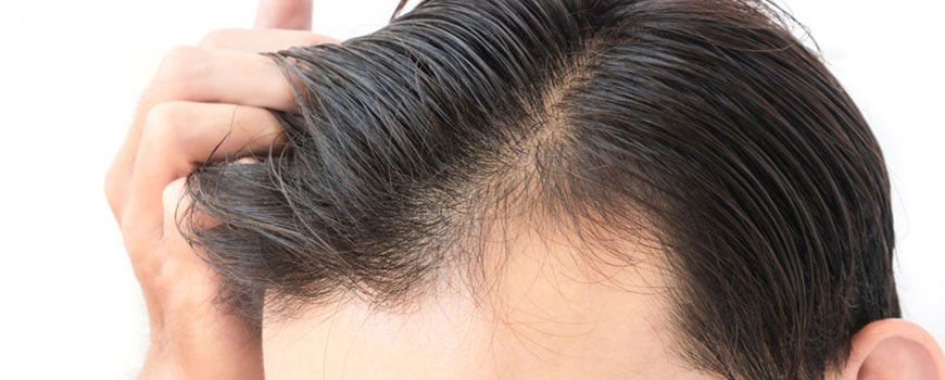 Trị rụng tóc bằng thuốc Dutasteride có hiệu quả không?