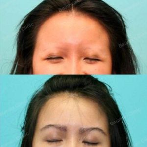 Cấy lông mày, nữ ca 1 - Bauman Clinic