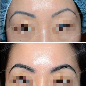 Cấy lông mày Bauman Clinic - ca 2