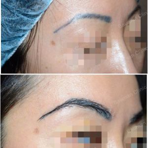 Cấy lông mày Bauman Clinic - ca 2