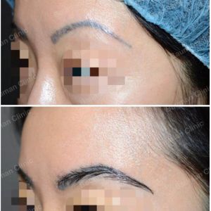 Cấy lông mày Bauman Clinic - ca 2