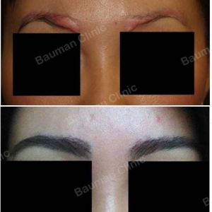 Cấy lông mày sửa sẹo lông mày - ca 3