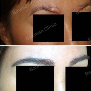 Cấy lông mày sửa sẹo lông mày - ca 3