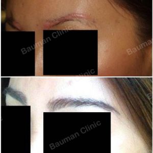 Cấy lông mày sửa sẹo lông mày - ca 3