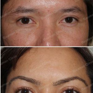 Cấy lông mày nữ Bauman Clinic - ca 4