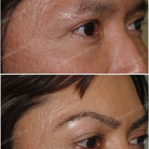 Cấy lông mày nữ Bauman Clinic - ca 4