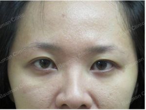 Cấy lông mày Bauman Clinic - ca 5