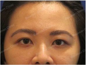 Cấy lông mày Bauman Clinic - ca 5