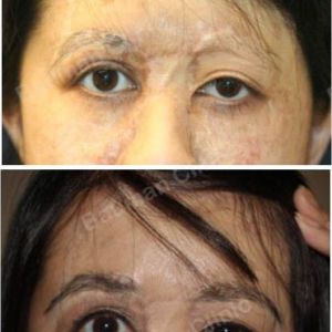 Cấy lông mày chỉnh sửa sẹo do bỏng - ca 6
