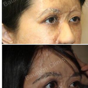 Cấy lông mày chỉnh sửa sẹo do bỏng - ca 6