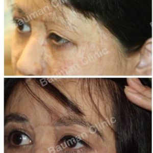 Cấy lông mày chỉnh sửa sẹo do bỏng - ca 6