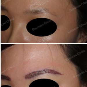 Cấy lông mày Bauman Clinic - ca 7