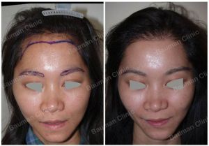 Cấy lông mày và cấy tóc nữ Bauman Clinic - ca 8